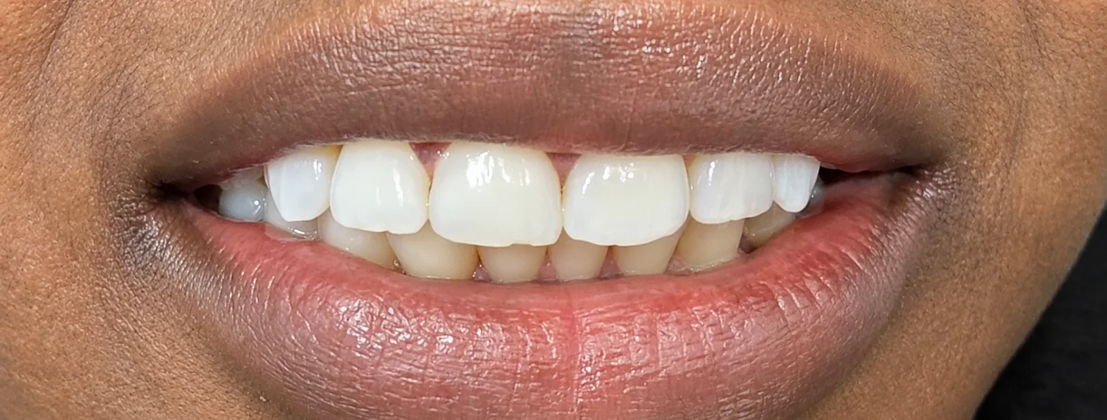 Before composite edge bonding