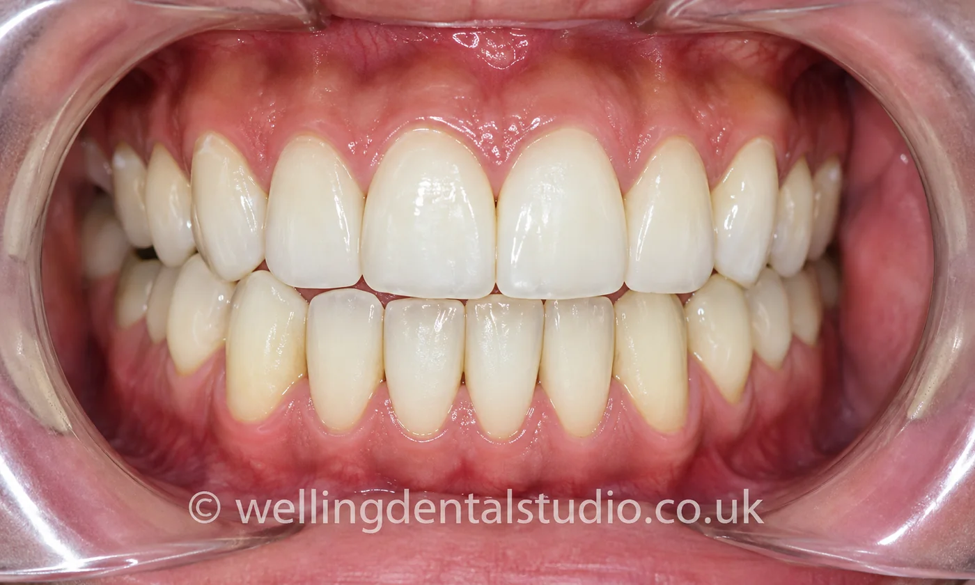 After composite veneers